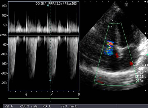 超音波ドプラ法による心臓弁逆流の検査