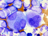 白血病細胞（慢性骨髄性白血病）