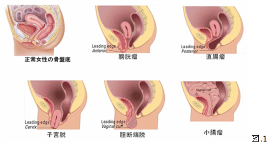 骨盤臓器脱の説明 杏林大学