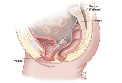 骨盤臓器脱の説明 杏林大学