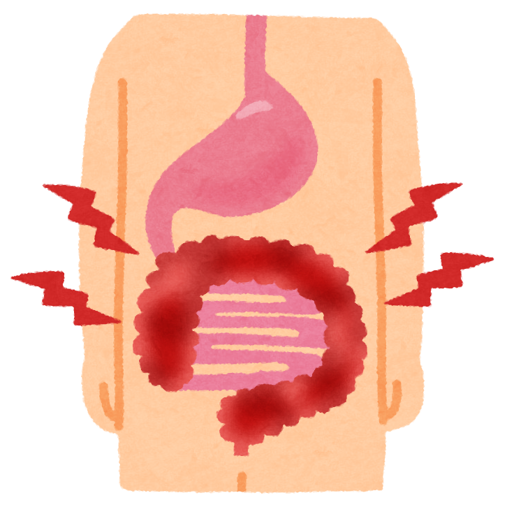 潰瘍性大腸炎ってどんな病気 病院 診療科について 杏林大学医学部付属病院 Kyorin University Hospital