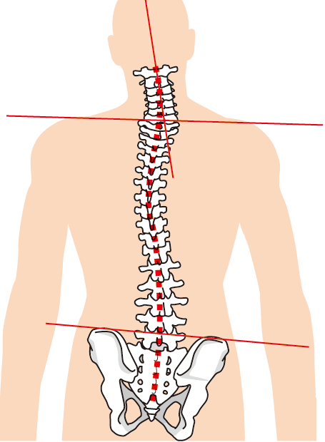 脊柱変形 側弯症 腰曲がり 病院 診療科について 杏林大学医学部付属病院 Kyorin University Hospital