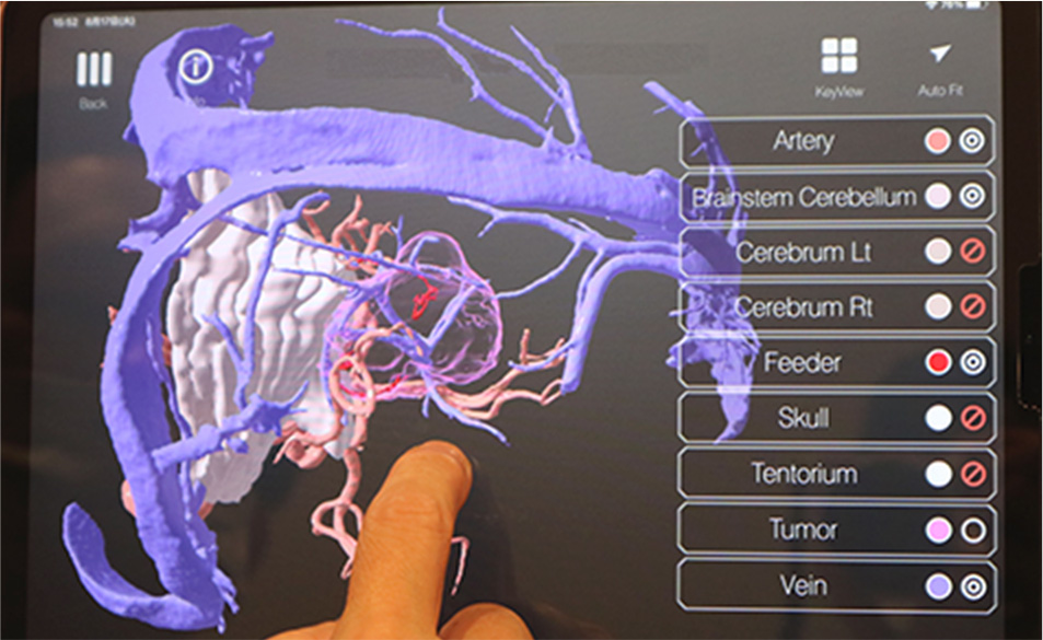 3Dグラフィックス化された脳。腫瘍の奥の血管の位置を確認(左)。