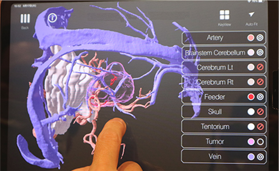 3Dグラフィックス化された脳。腫瘍の奥の血管の位置を確認(左)。